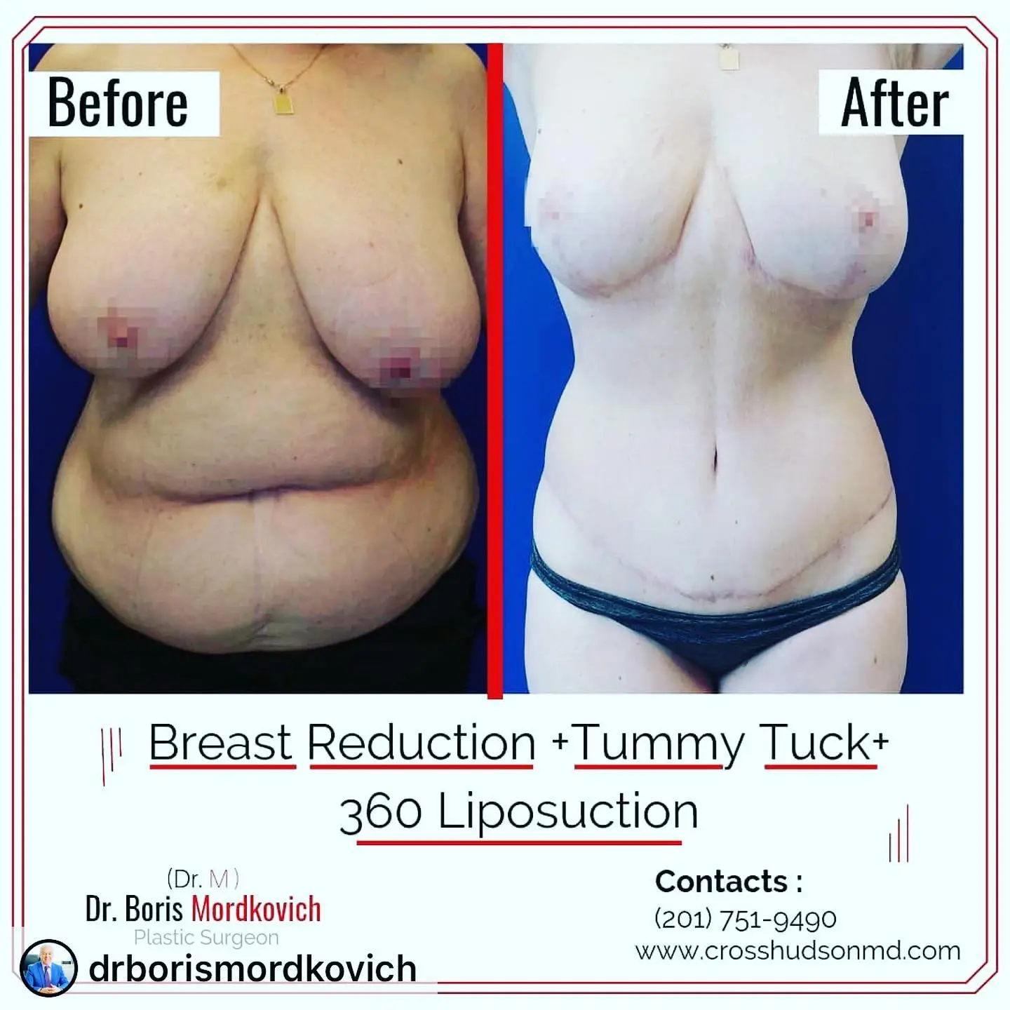 Before and after breast reduction and tummy tuck with 360 liposuction by Dr. Boris Mordkovich